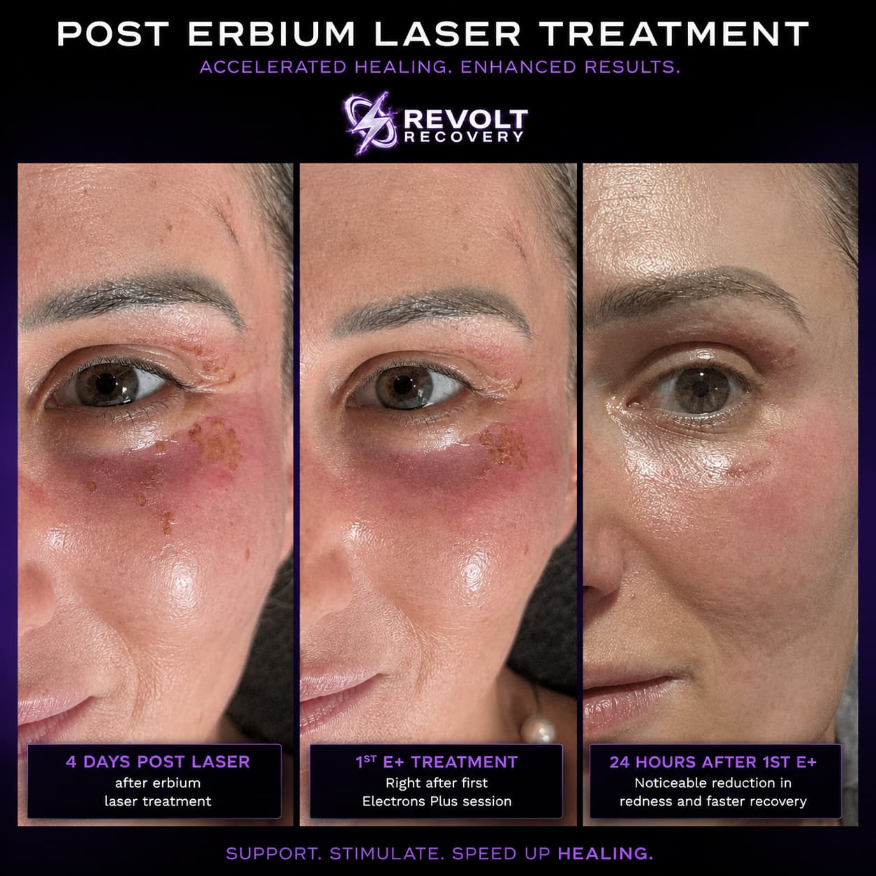 Recovery after an erbium laser treatment across three stages: four days post laser, immediately after the first Electrons Plus session, and 24 hours later showing noticeably reduced redness.